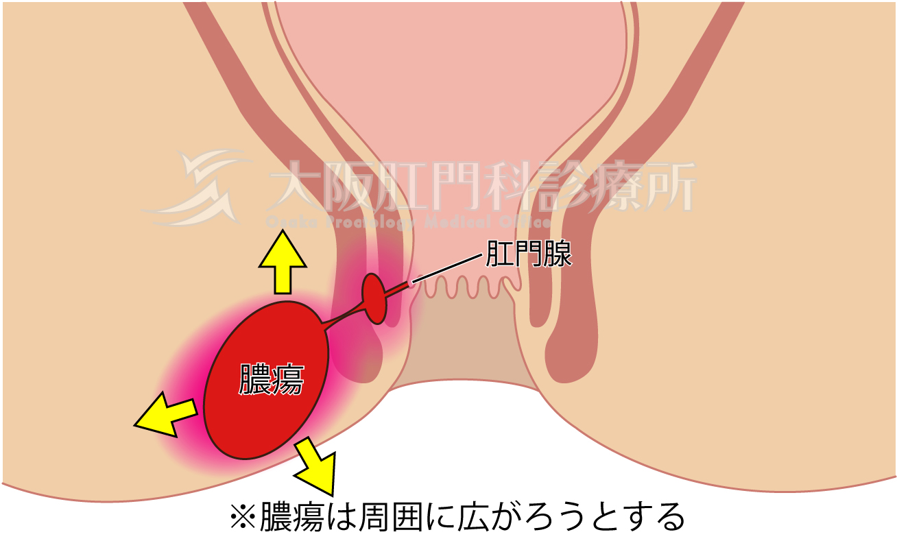 ケツの中にイボがあるからアナニー開発とかできない俺の話